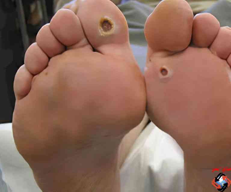 طرق الوقايه من القدم السكري